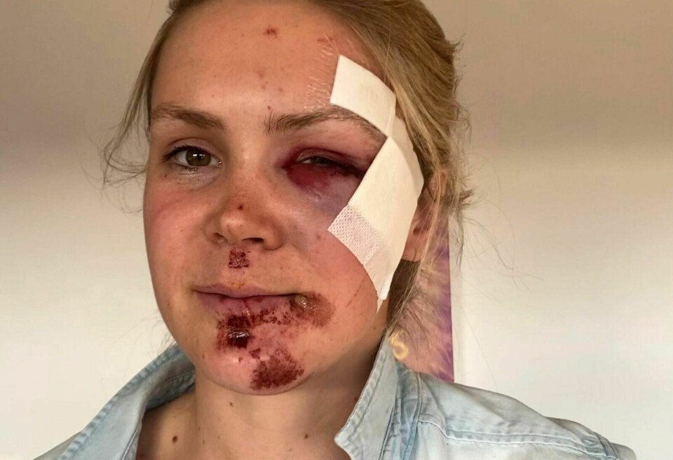 SLAPP MED SKREKKEN: Karoline Knotten var utsatt for en stygg sykkelulykke i Lillehammer lørdag, men slapp med skrekken – og noen skrubbsår. Foto: Privat